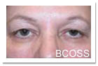 Lower Blepharoplasty(Eyelid Surgery)